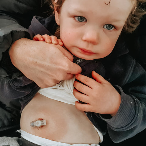 Young boy in mum's arms with gastrostomy button in belly