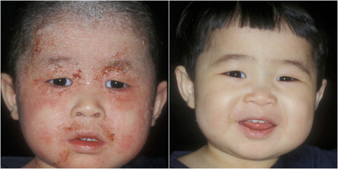 Baby with eczema before & after picture