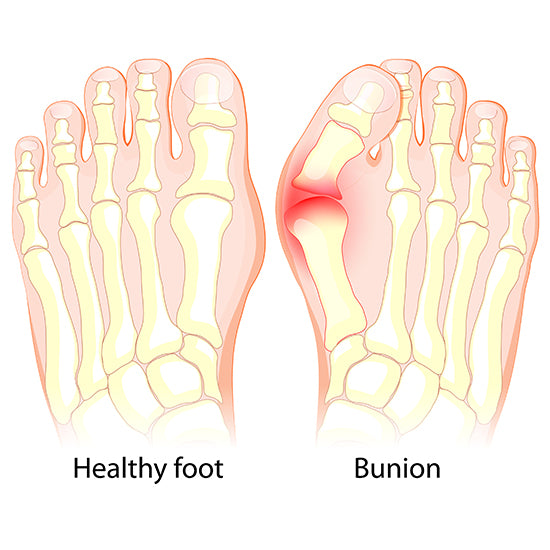 A diagram of a healthy foot and one with a bunion.