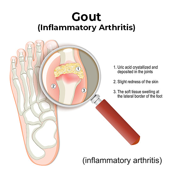 A diagram of how gout affects the joints in the foot.