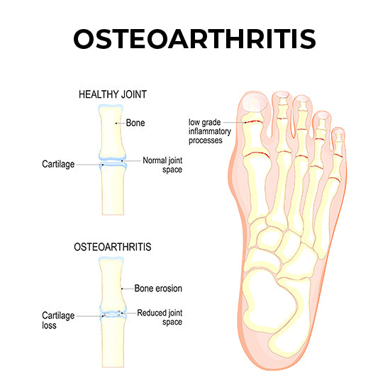 A diagram of how osteoarthritis affects the joints in the foot.