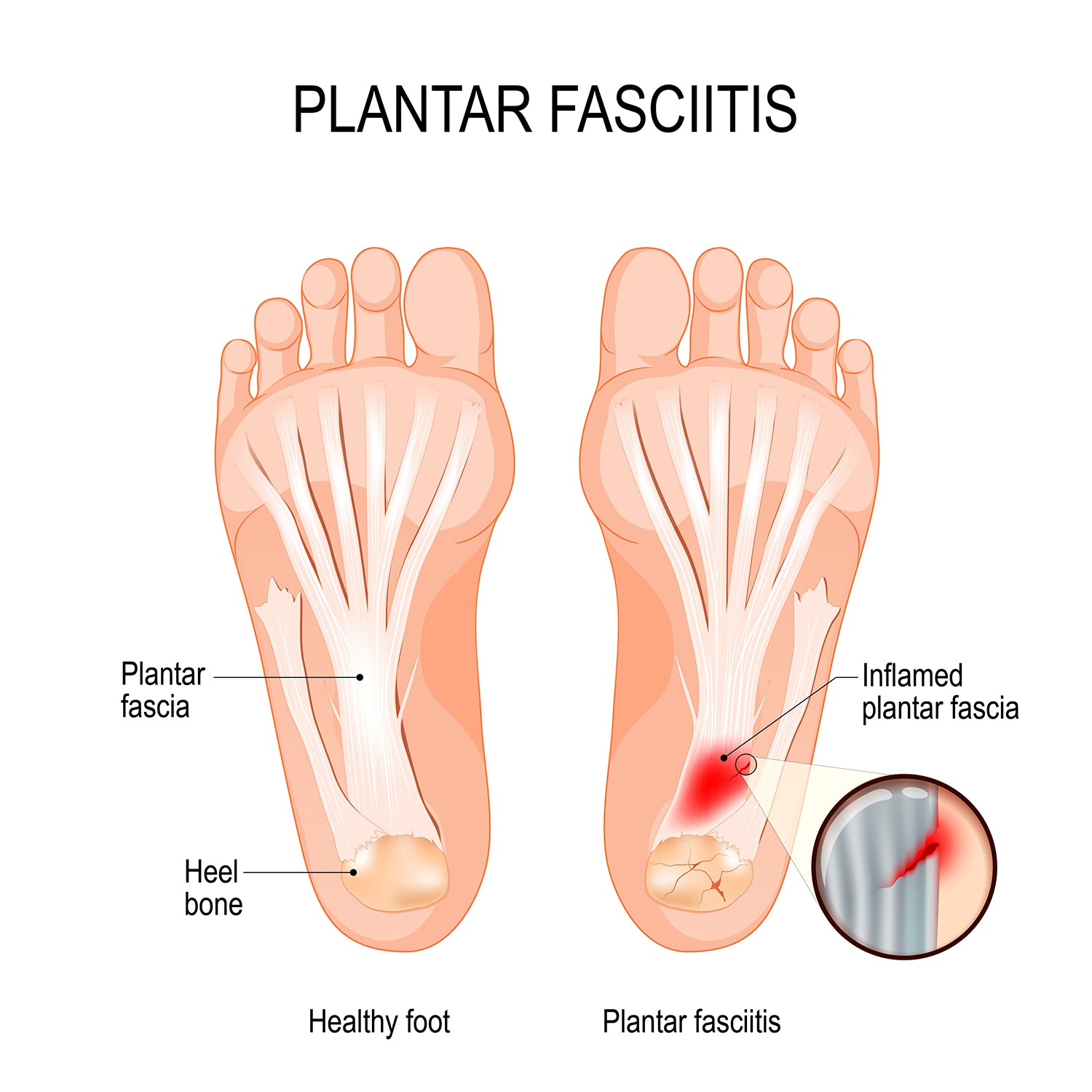 Diagram of a healthy foot and one with plantar fasciitis.