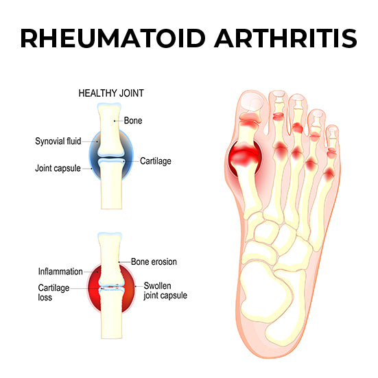 A diagram of how Rheumatoid arthritis affects the joints in the foot.