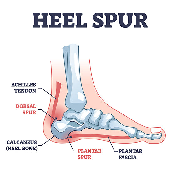 A diagram of a foot with a heel spur.