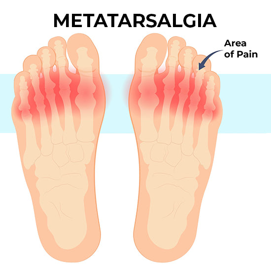 Diagram showing what area metatarsalgia affects.