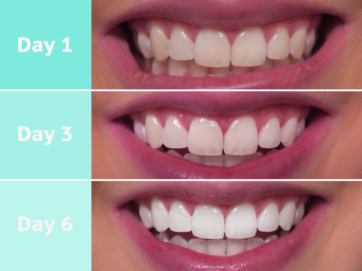 Sakura Smile | LED Teeth Whitening Set | At-Home Teeth ...