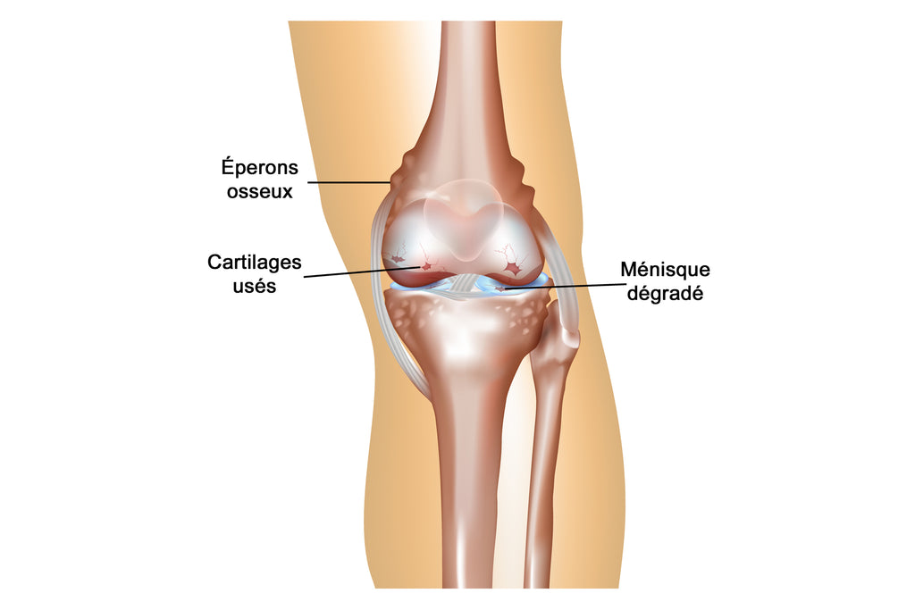 Image Qui Montre Les Cartilages Usés Par Une Arthrose Du Genou - Avec Formation D'éperons Osseux