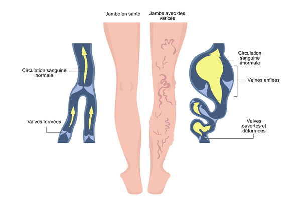 Image illustrant une jambe atteinte de varice vs une jambe en santé