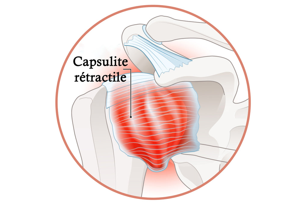 Épaule Atteinte D'une Capsulite Rétractile Où On Voit L'inflammation Et La Formation D'adhérences Autour De La Capsule