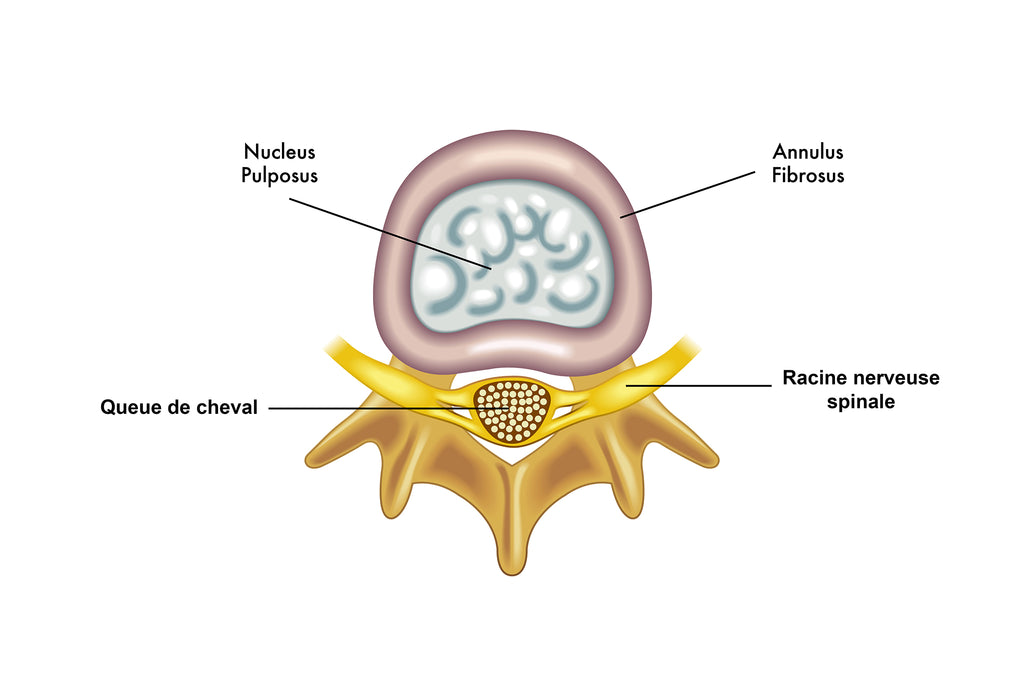 Vue de L'intérieur du Disque Intervertébral: On Voit Le Nucleus Pulposus, Le Annulus Fibrosus et La Racine Nerveuse