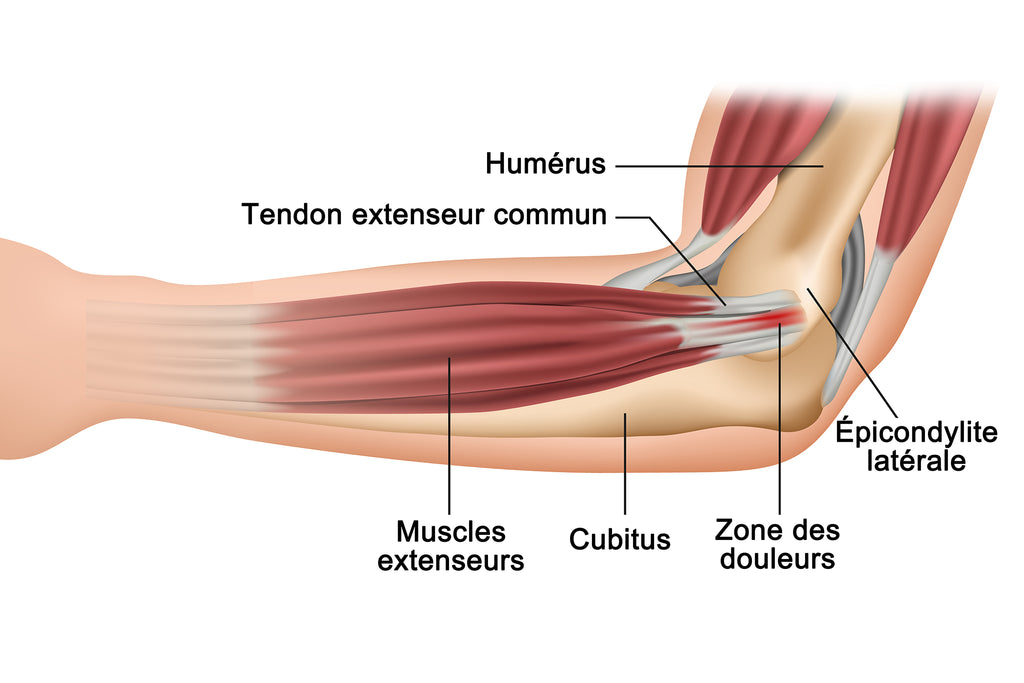 Image Qui Illustre Une Épicondylite Latérale - Tennis Elbow Au Niveau Du Tendon Extenseur Commun