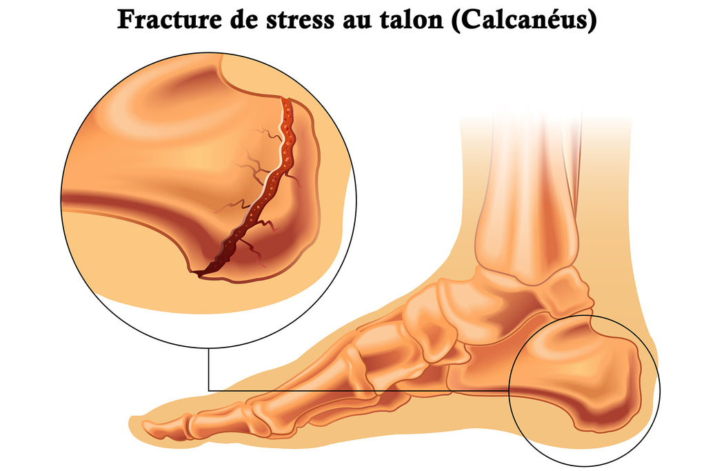 Illustration D'une Fracture De Stress Au Talon - Calcanéus - Avec Vue Rapprochée