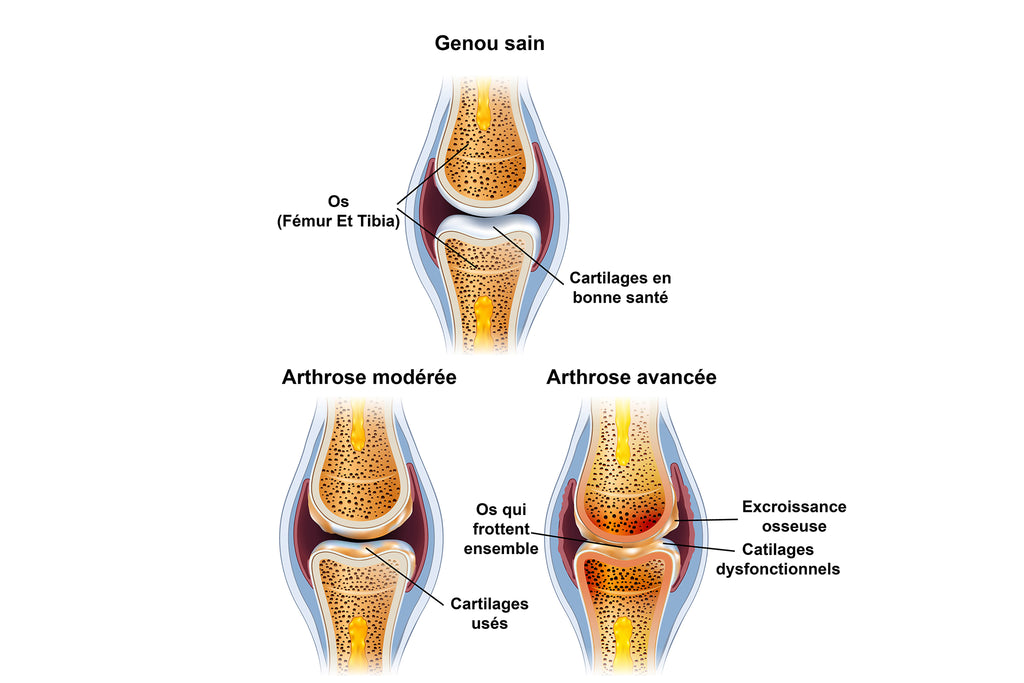 Image Démontrant Les Trois Stades De La Gonarthrose - Avec Vue Des Cartilages Usés