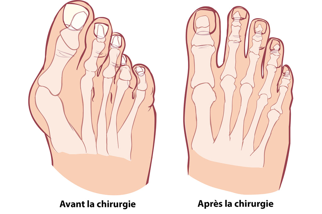 Chirurgie De Hallux Valgus - Vue Du Pied Avant Et Après