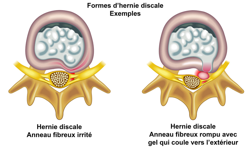 Vue Rapprochée Du Disque Montrant Deux Formes De Hernie Discale: Légère Et Sévère