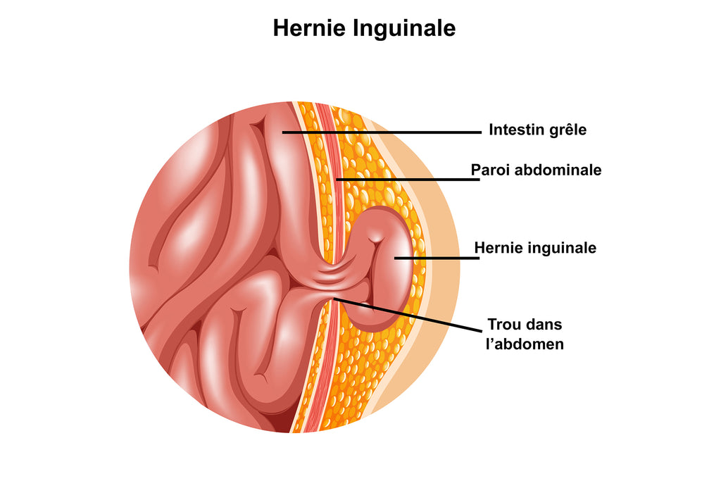 Hernie Inguinale: Vue Proche Du Bout De L'intestin Qui Déborde Par Un Trou À L'abdoment- Illustration