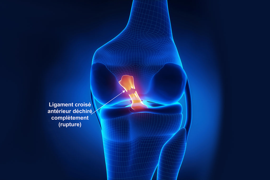 Ligament Croisé Antérieur  Déchiré - Illustration En 3D