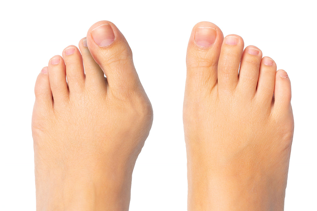 Vrai Pied En Prise Avec Un Hallux Valgus - Vue Proche Des Deux Pieds