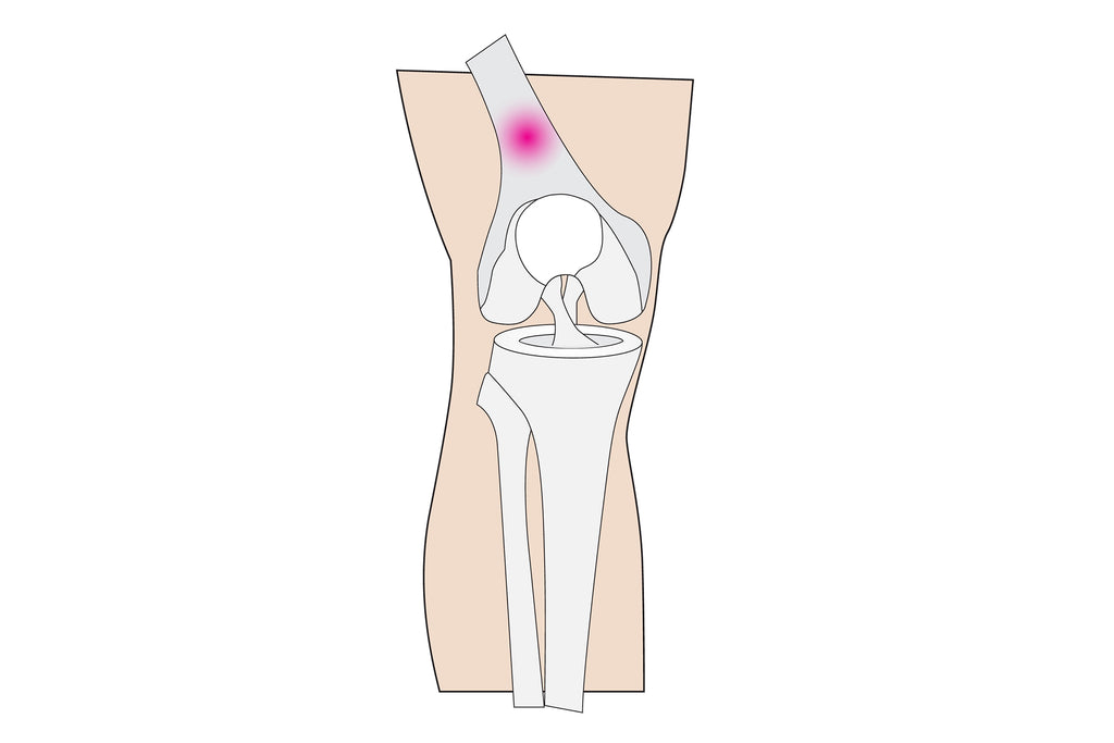 Jambe En Prise Avec Une Tendinite Au Genou - Illustration Pour Blogue