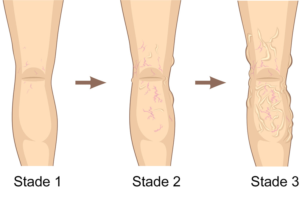 Photo Qui Démontre Les Trois Stades De La Varice