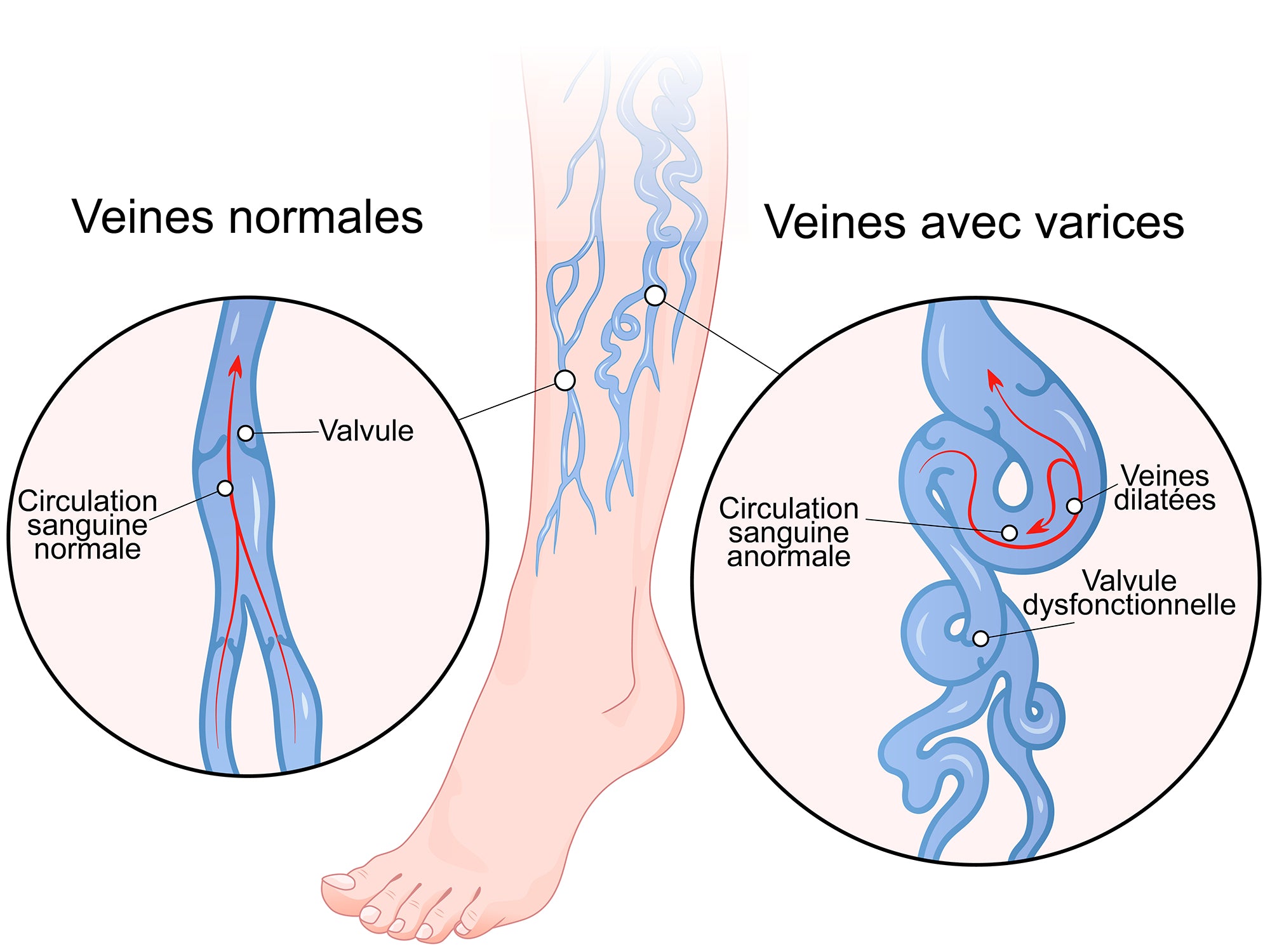 Vue Proche D'une Varice Aux Jambes Versus Une Veine Normale