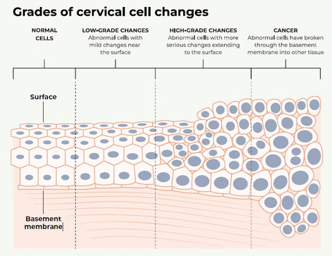 Grades of cervical cell changes