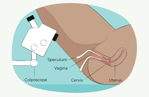 Colposcopy