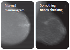 In a normal mammogram, the breast tissue appears an even grey. In an abnormal mammogram, there is an area of the breast that appears lighter.