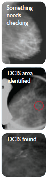 A mottled-appearing mammogram indicates something needs checking. An area of microcalcifications that may be DCIS is indentified, and the DCIS found.