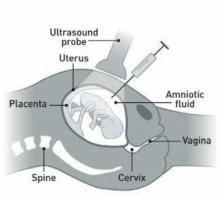 Amniocentesis - shows needle being inserted through the belly into the amniotic fluid