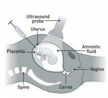 Chorionic villus sampling - shows needle being inserted through the belly into the placenta