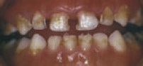 Unhealthy teeth – these have brown stains on them.