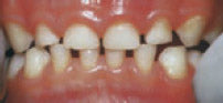 Healthy teeth – these are white, with little staining.