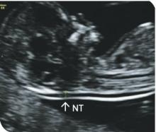 Image 3 - the nuchal translucency scan showing the fluid-filled space at the back of the baby's neck