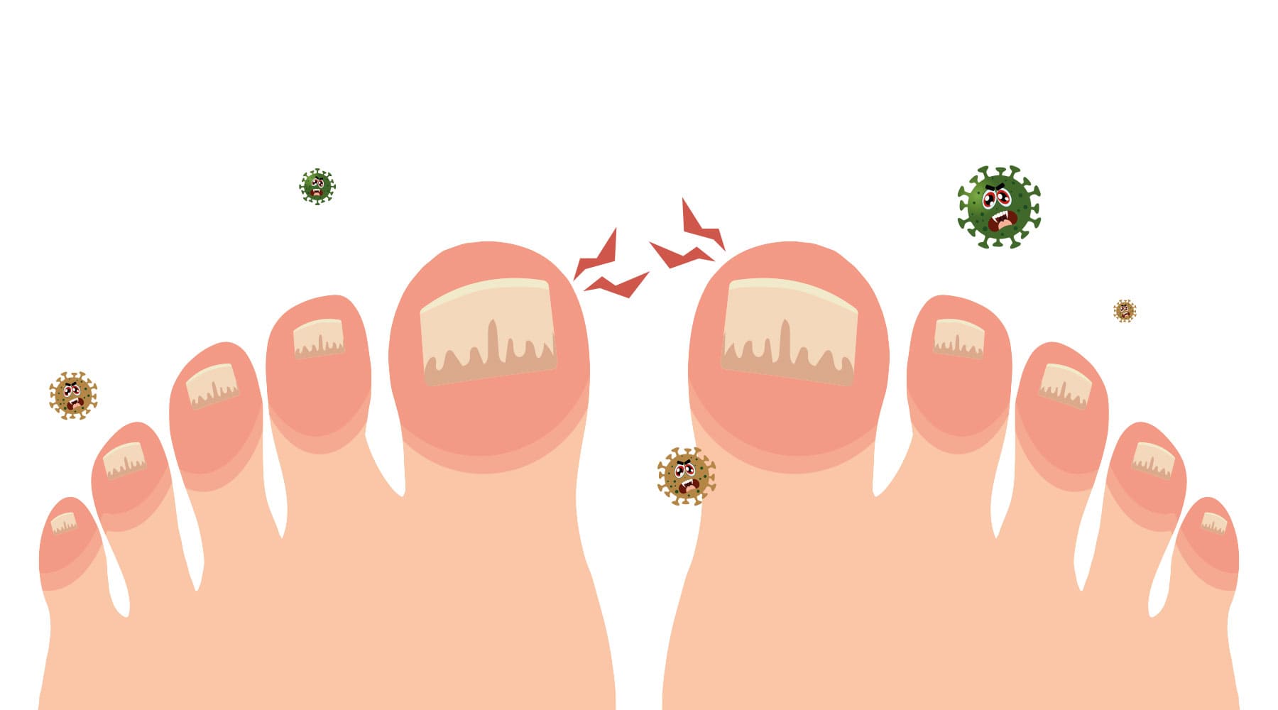 Nail Infection Disease Minimal Infographic Banner Vector By Pikepicture |  TheHungryJPEG