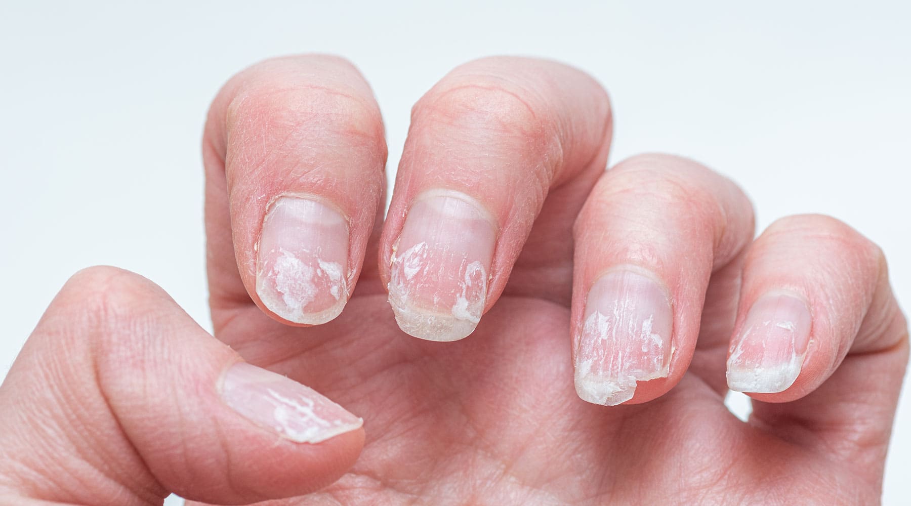 Damaged Nervous Nails, Biting Nails on Fingers Stock Photo - Image of finger,  hand: 134997178