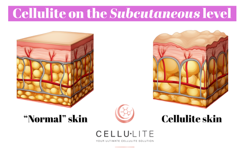 cellulite diagram on skin