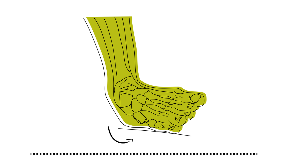 Illustration of a sprained ankle