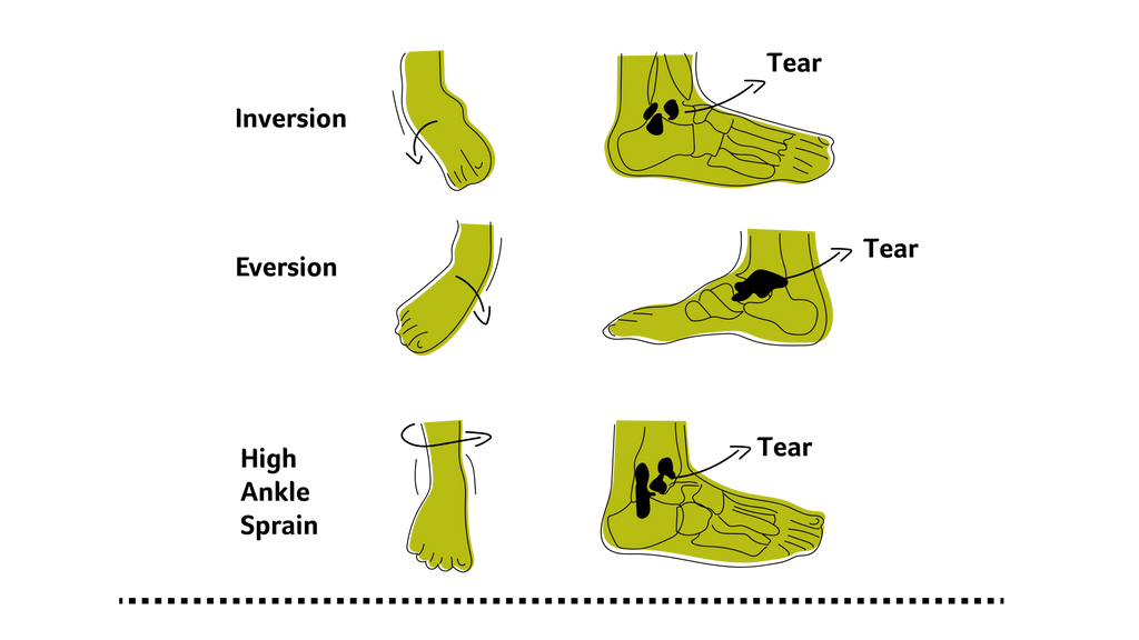 Illustration of the different kind of ankle problems