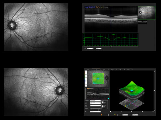 A screenshot of an optical coherence tomography (OCT) scan. 