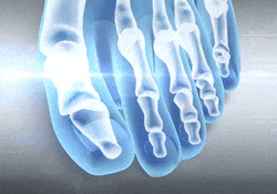 Orthopedic Toe Corrector Deals Streak