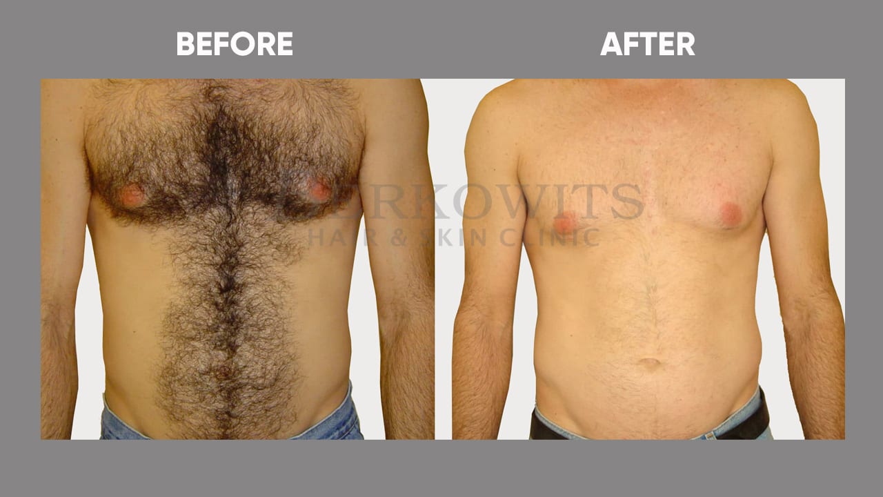 Ful Body Laser Hair Removal Cost Delhi  Dr Syed