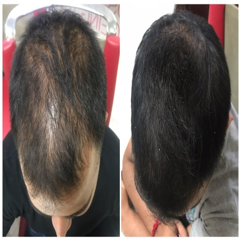 Five Step Female Hair Loss Treatment  Parsa Mohebi Hair Restoration