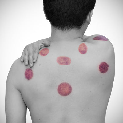 Cupping Blisters - How to avoid and causes from Lierre.ca Canada