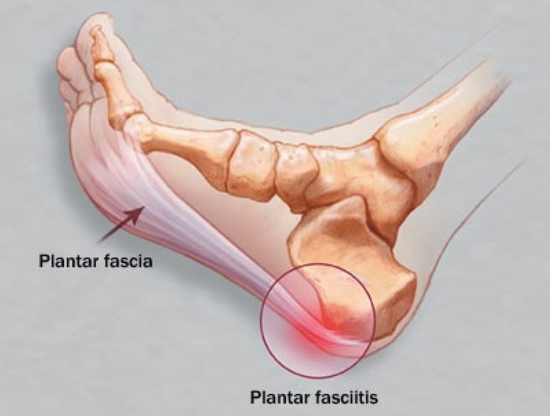 Diagram of Plantar Fasciitis - What to Look for in Plantar Fasciitis Shoes