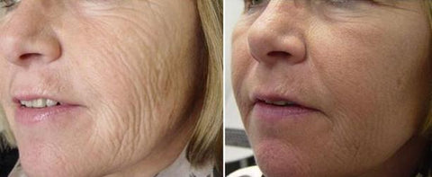 How Dermarolling Causes Collagen Breakdown Premature Aging And Possi O U M E R E