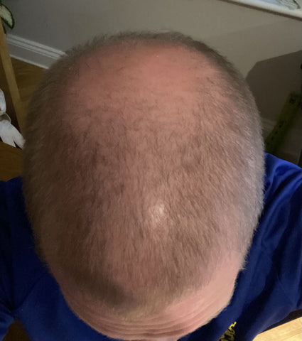 Scalp Psoriasis