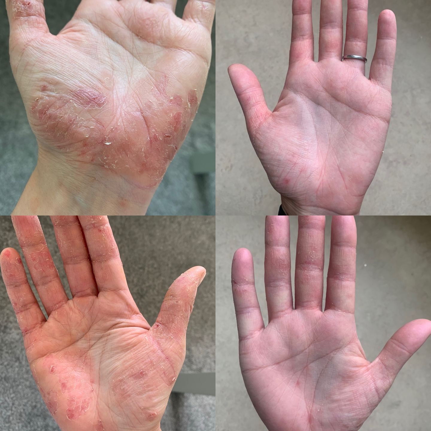 Customer's Hand with eczema