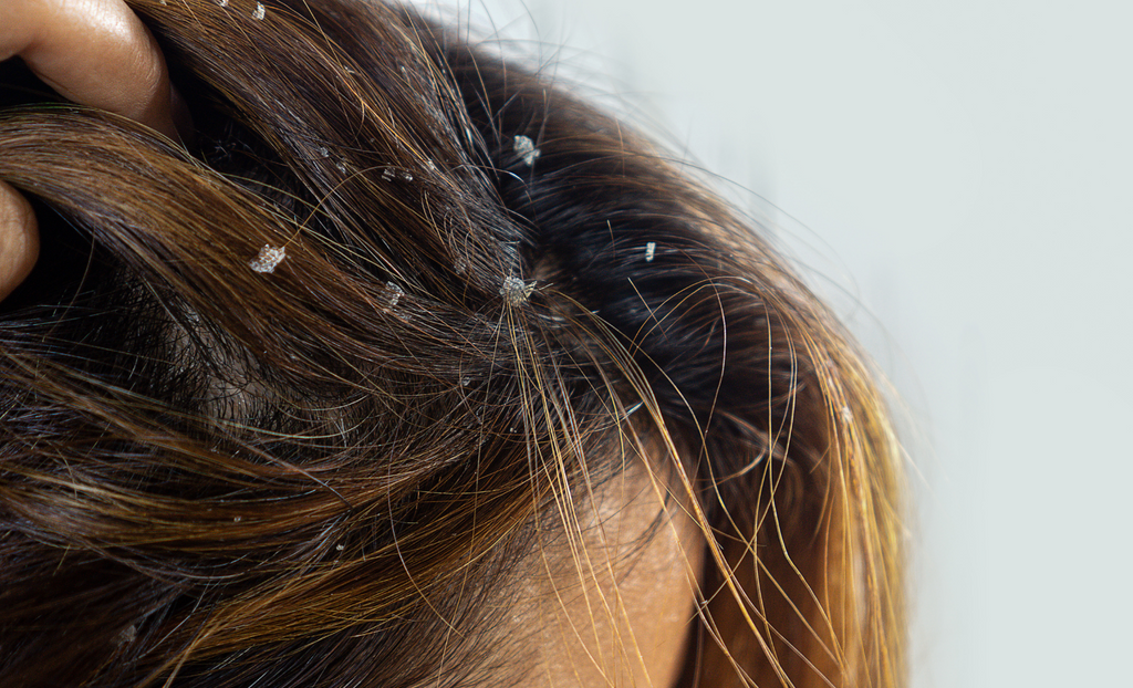 Dos and Donts for Scalp Psoriasis