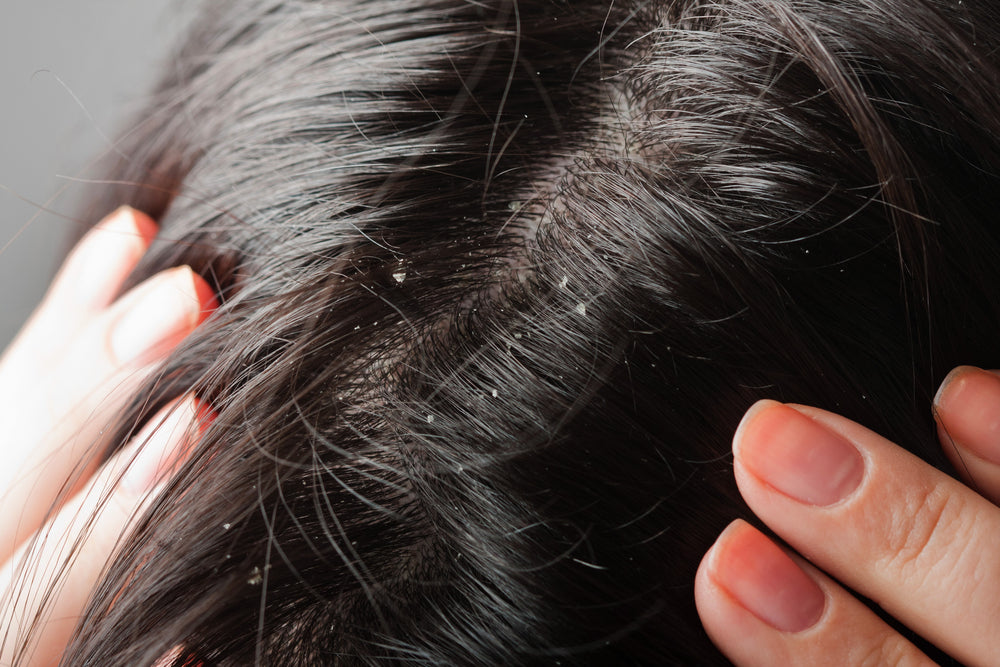 Close up flaky dandruff scalp